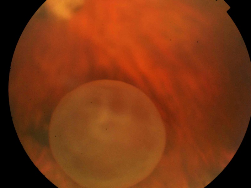 File:Cysticercosis.jpg