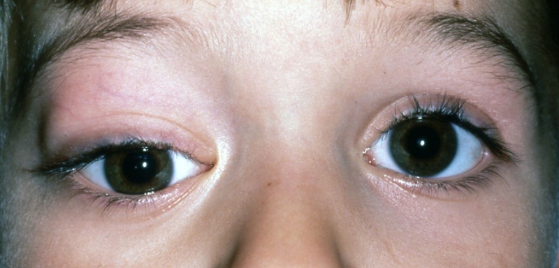File:Rhabdo Figure 2.jpg
