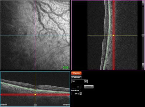 Enhanced En Face OCT Image of Choroidal Vasculature Using Flattening and Slab Adjustments