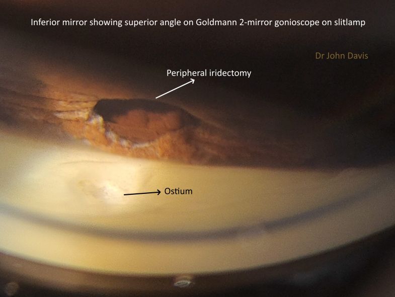 Figure 2: Gonioscopic view of superior angle with Trabeculectomy ostium and Peripheral iridectomy visible