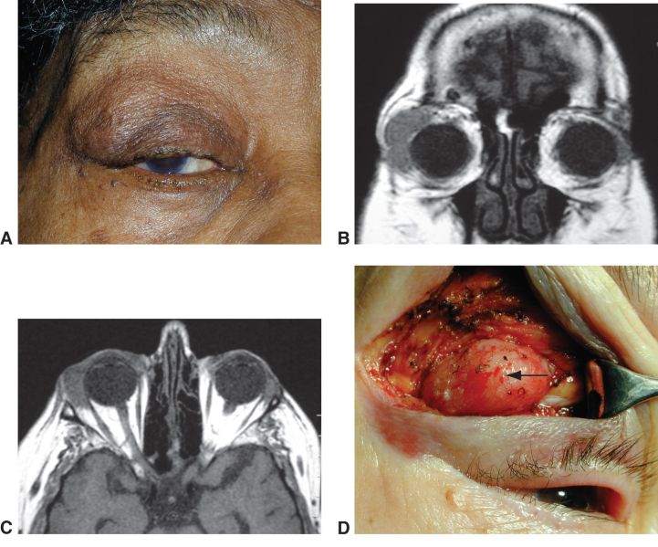 File:Lymphoproliferative lesion.jpg