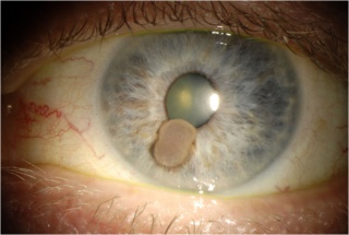 Figure 1A: Clinical picture showing a light brown circumscribed mass.
