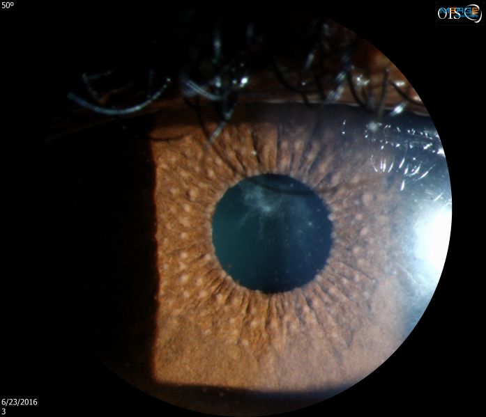 File:Fuchs Uveitis Syndrome .jpg