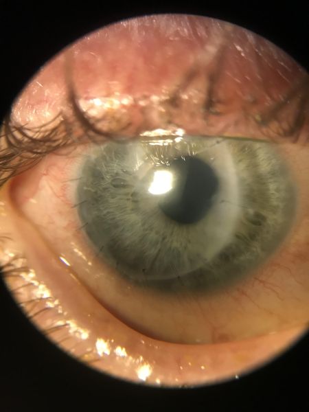 File:Rotational Autograft Martinez.jpg