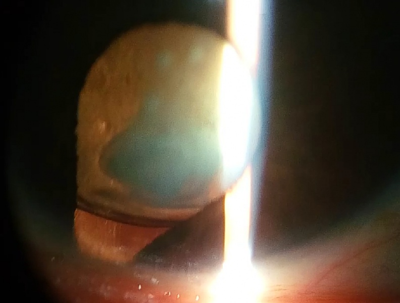 File:Iris coloboma with cataract.jpg
