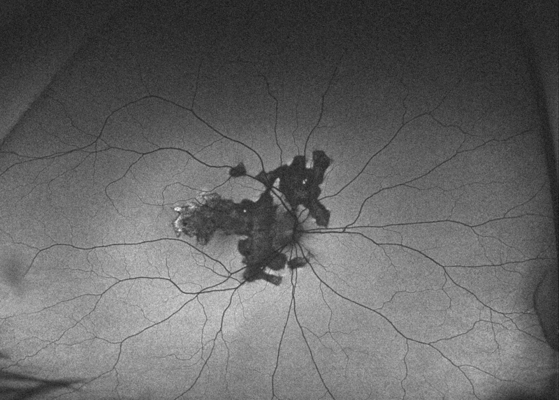 File:Serpiginous AF.png