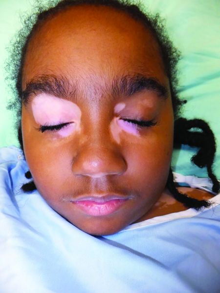 File:Vitiligo.jpg