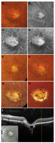 File:North Carolina Macular Dystrophy.png