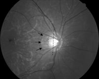 Optic disc tilting with beta peripapillary atrophy in a 14-year-old boy with spherical equivalent refraction of −6.60 diopters and axial length of 26.30 mm. Solid arrows = edge of beta peripapillary atrophy; dotted line = axis of tilted disc.