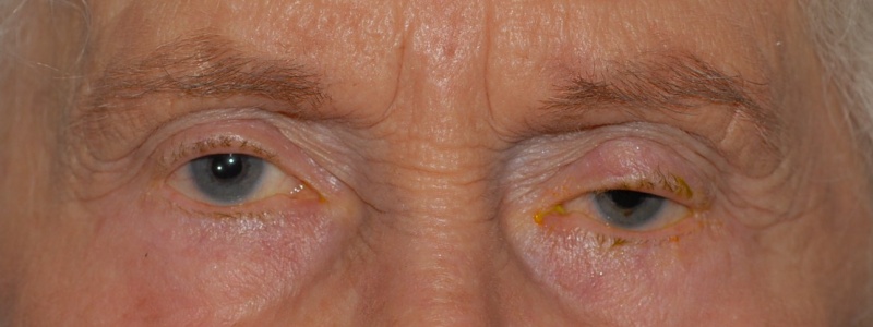 File:Ptosis from bleb.JPG