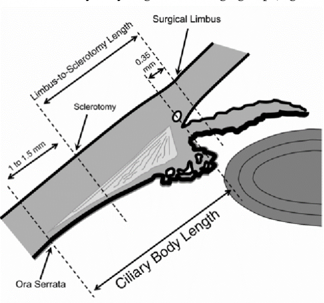 File:Way to trocar insertion.png