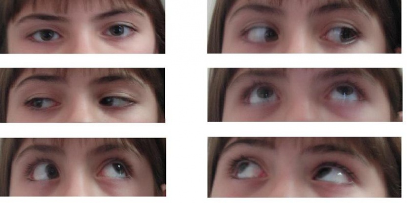 File:Brown-syndrome.JPG