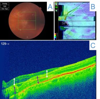 A: Fundus image highlighting the scanned area (green box) over the macula. B: Color-coded macular thickness map showing irregularities caused by motion artifact, reflected as discontinuities or streaks and uneven color patterns in the retinal thickness distribution. C: Cross-sectional OCT scan illustrating the effects of motion artifact. The white arrows indicate double scanning of the same or neighboring areas, while the purple arrows highlight the continuation of retinal layers. (Courtesy of J. Khadamy)