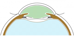 No viscoelastic in the bag.png