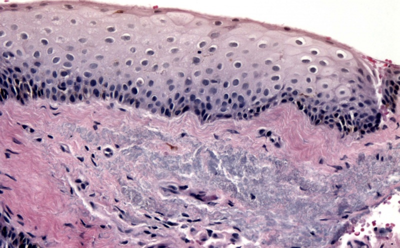 File:Pinguecula H&E.jpg