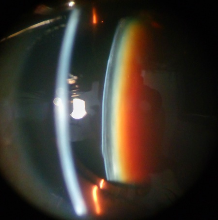 Black Cataract - EyeWiki