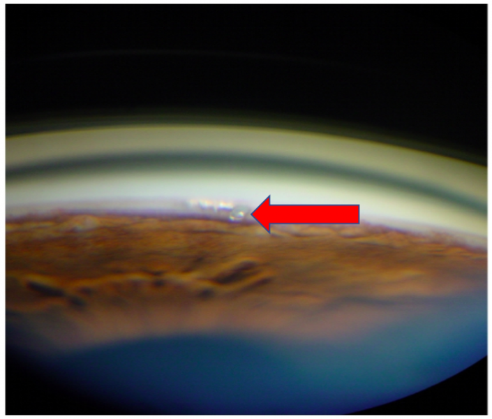 File:Gonioscopic view iStent.png