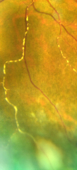 Toxoplasmosis - EyeWiki