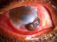 Peripheral ulcerative keratitis is a rare but potentially devastating corneal emergency. It is characterized by crescentic-shaped peripheral ulceration and may involve the sclera and conjunctiva. The etiology includes immune-mediated systemic diseases such as granulomatosis polyangiitis and rheumatoid arthritis, immune-medicated ocular diseases such as Mooren’s ulcer and non-immune mediated conditions, especially infective etiology. A host of other conditions can also mimic this entity. The patient can present in the advanced stage with corneal perforation, necessitating emergency tectonic procedures.