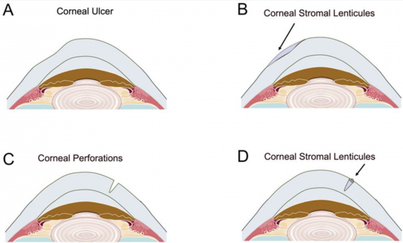 File:Ulcers and perfs smile.png