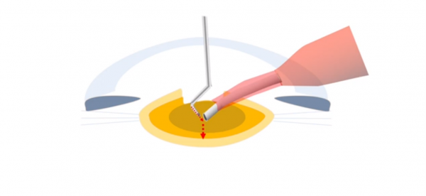 Vertical Chop Technique - EyeWiki