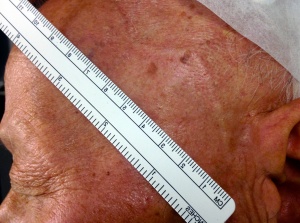 Preoperative appearance of a patient with a prominent left superficial temporal artery. The vessel was tender and pulseless. Histopathology confirmed a positive result for temporal arteritis in this case. Image courtesy of Marcus M. Marcet, MD FACS.