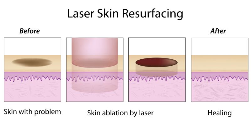 File:Non-Fractional Laser Skin Resurfacing.jpg