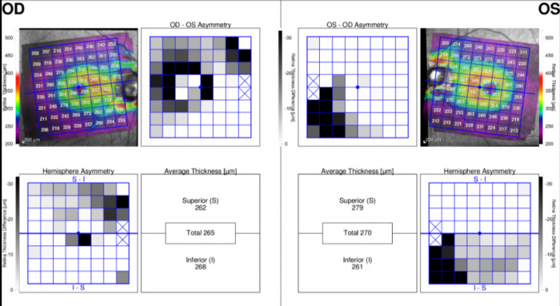 File:Spectralis Asymmetry analysis.PNG