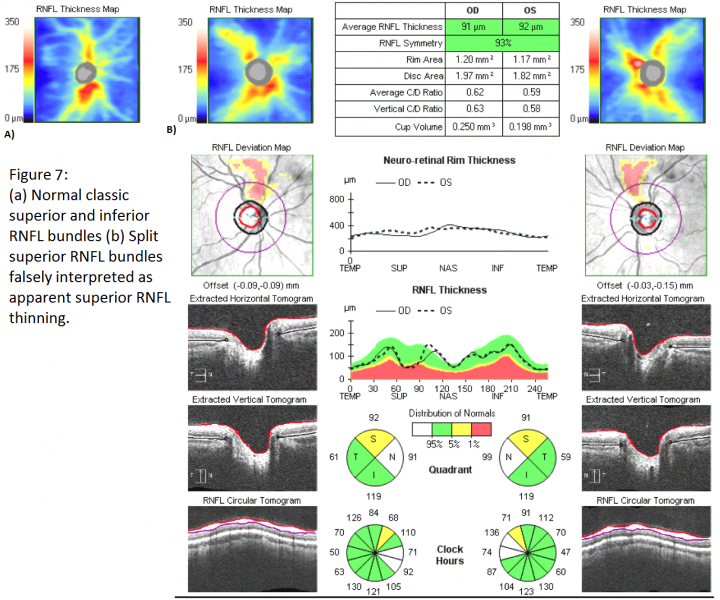 File:Figure 7 SD-OCT.png