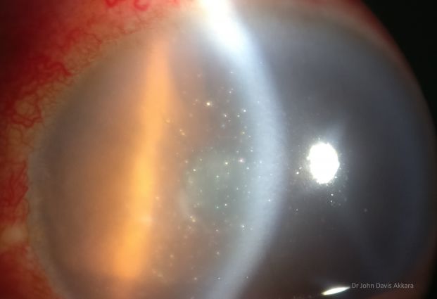 Phacolytic glaucoma - sparkling particles in AC