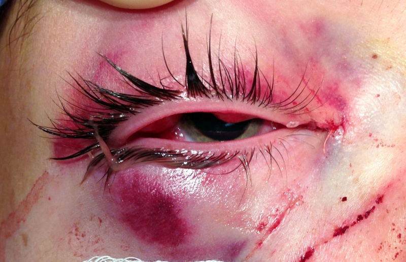File:Cropped Repaired Canalicular Laceration.jpg
