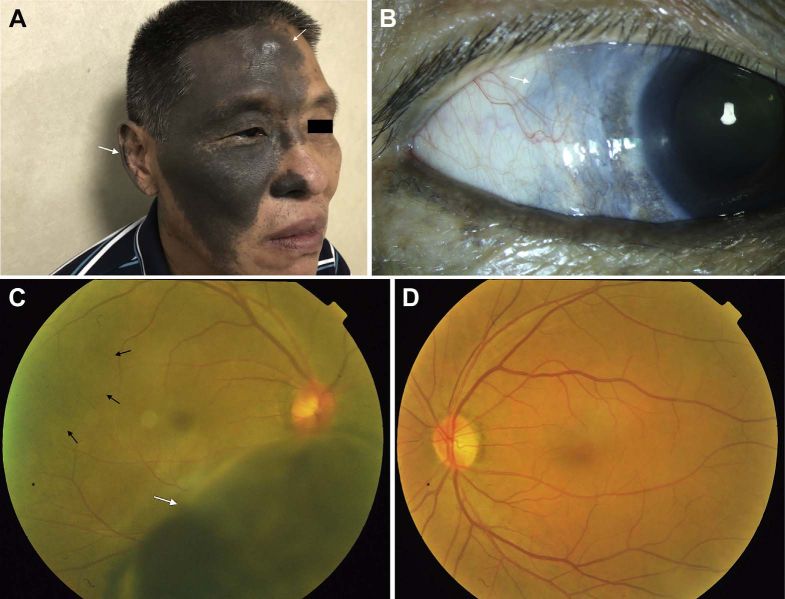 File:Skin pigmentation-2.jpg