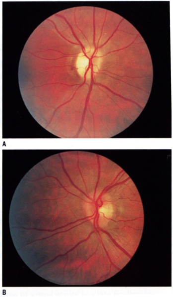 File:Opticatrophy.png