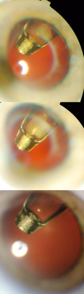 File:PDS Septum Dislodgement.png