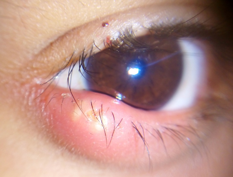 File:External hordeolum.jpg