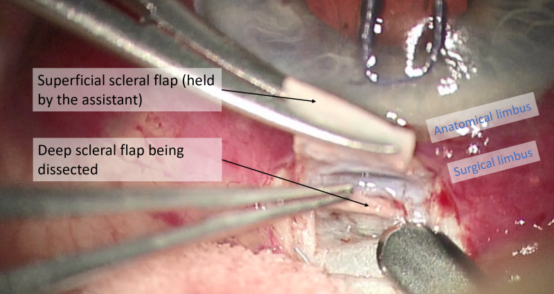 File:Fig 5 scleral flap held.png