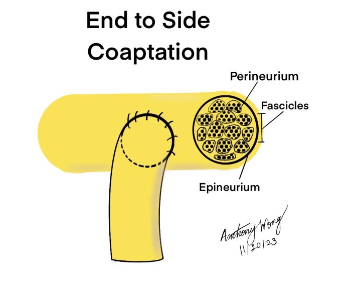 File:End to Side Coaptation.jpg