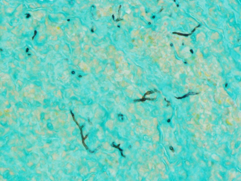 File:Fungal hyphae, GMS stain, 60X.jpg
