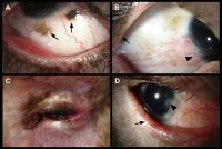 Lid and ocular surface manifestations in patients with xeroderma pigmentosum (XP). A, Conjunctival melanosis (arrows) in case 5, an 8-year-old Asian Indian XP-C patient (XP417BE). Note the feeder vessels to lesions (arrows). B, Early pterygium (arrowhead) and lid pigmentation (arrow) in case 2. C, Severe ectropion, entropion, and ocular inflammation in case 3. D, Lid margin keratinization (arrow) and loss of lashes in case 6, a 14-year-old patient (XP243BE). The patient has a history of skin cancer but no history of ocular surface cancer. Lentigines are present on the eyelids, and the patient has bilateral pterygium (arrowhead) and ectropion. The patient has decreased best-corrected visual acuity, possibly due to amblyopia. Localized corneal clouding at the leading edge of pterygium was suspicious for early malignancy, and biopsy was recommended.