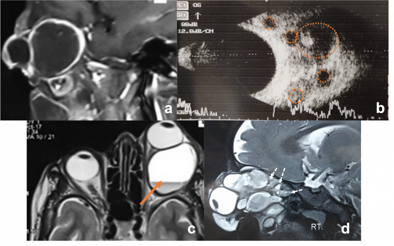 File:Lymphangioma.png
