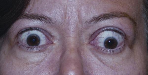 Exposure Keratopathy - EyeWiki