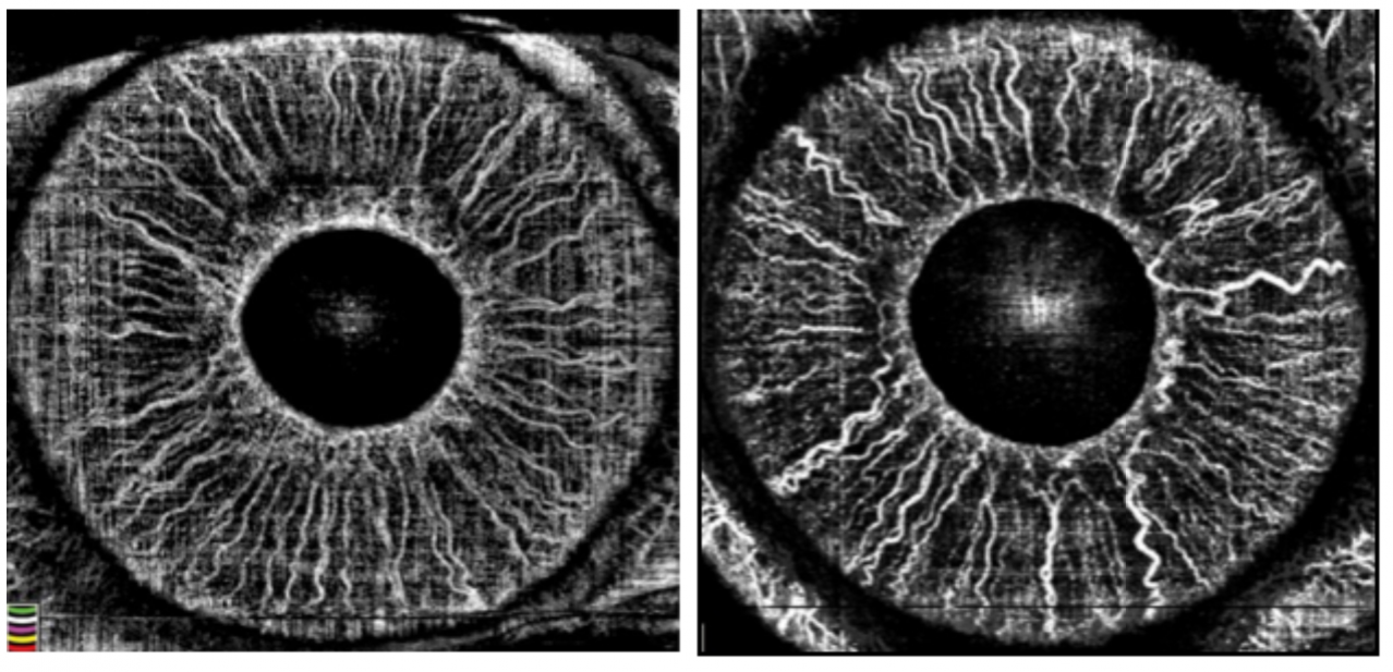 OCT-Angiography and Glaucoma - EyeWiki