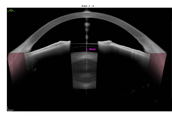 Phakic Intraocular Lenses - EyeWiki