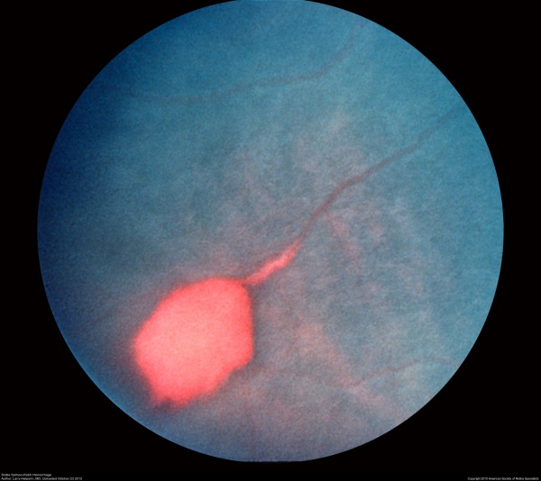(This image was originally published in the ASRS Retina Image Bank by Larry Halperin, MD, Retina Group of Florida. Sickle Salmon-Patch Hemorrhage. 2012; Image Number, 1789. © the American Society of Retina Specialists).