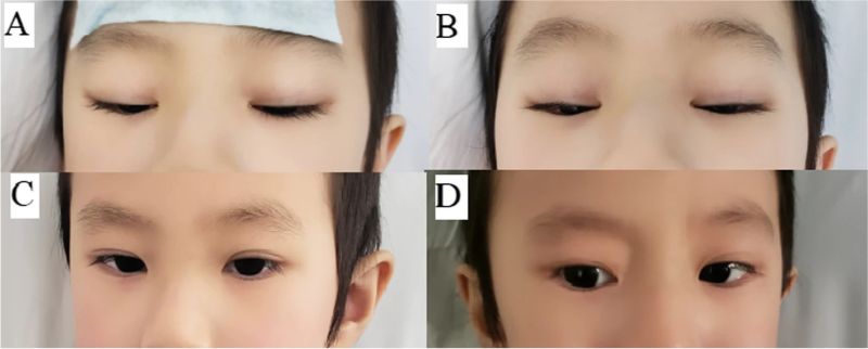 File:Kawasaki ptosis.jpg