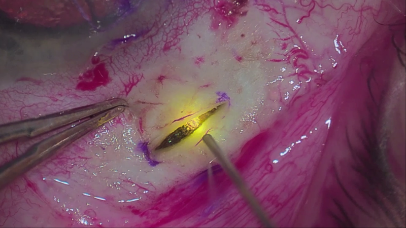 File:Pars plana laser ablation.png