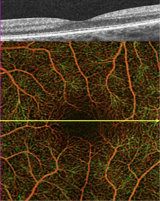 Optical Coherence Tomography Angiography - EyeWiki