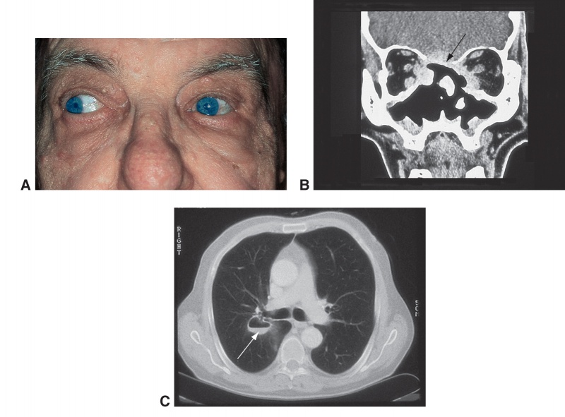 File:GPA image - AAO BCSC.jpg
