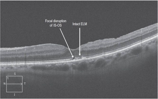 Optical Coherence Tomography - EyeWiki