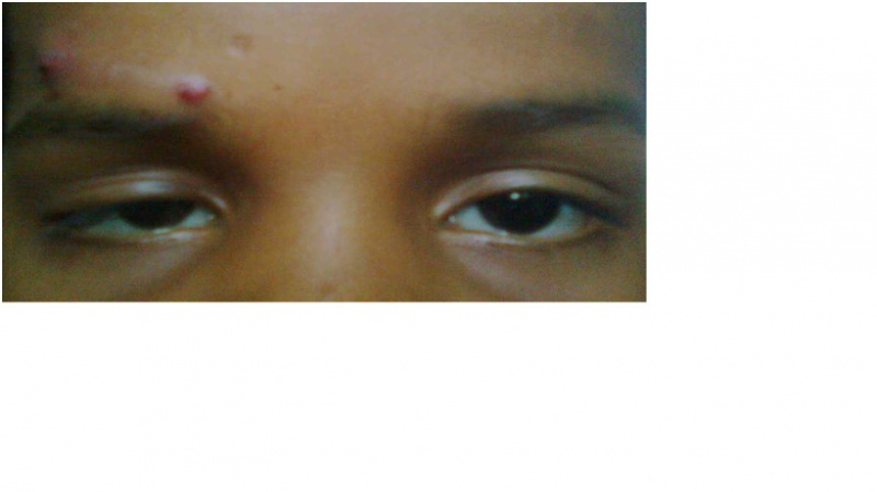 File:Ptosis.jpg